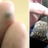 Cục nam châm được cấy vào ngón tay để hút kim loại
